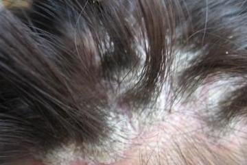 头部银屑病患者使用外用药对头发有何影响呢