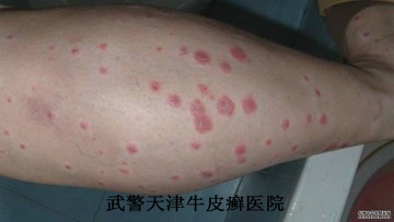 得牛皮癣的病因有哪些