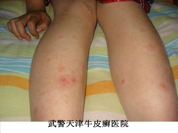 牛皮癣反复复发怎么办