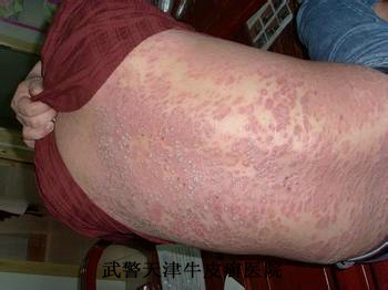 牛皮癣瘙痒怎么治疗以及护理