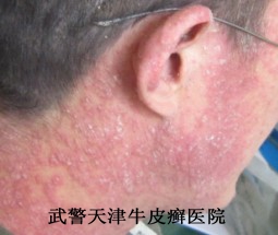 牛皮癣各时期症状是什么
