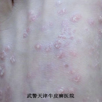预防牛皮癣复发的方法