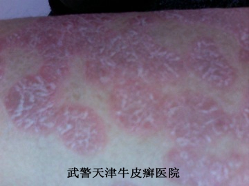牛皮癣应该如何预防复发