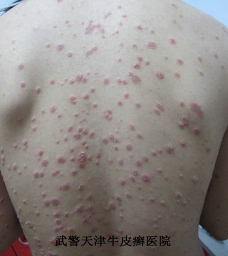 哪些是预防牛皮癣要点